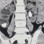 Врачи стали чаще диагностировать мочекаменную болезнь у детей