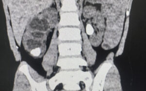 Врачи стали чаще диагностировать мочекаменную болезнь у детей